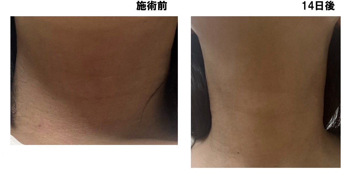 首プロファイロ施術前と14日後の比較写真