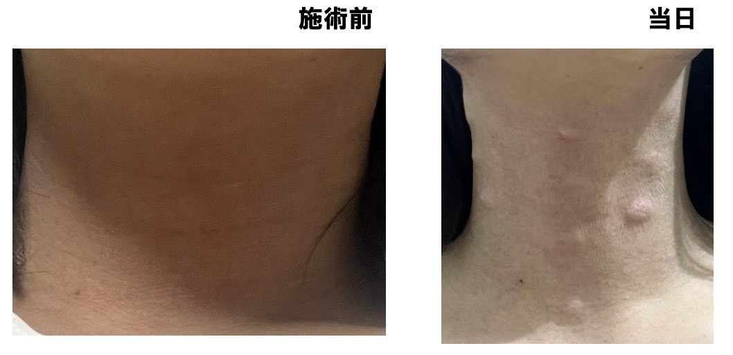 首プロファイロ施術前と施術当日のダウンタイム比較
