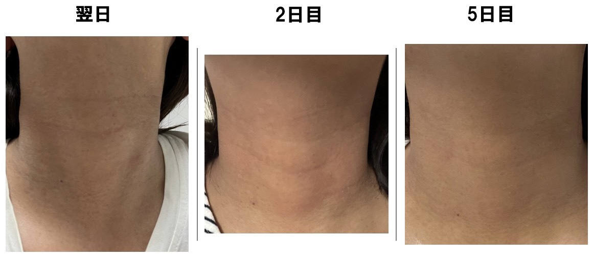 首プロファイロ翌日2日目5日目のダウンタイム経過